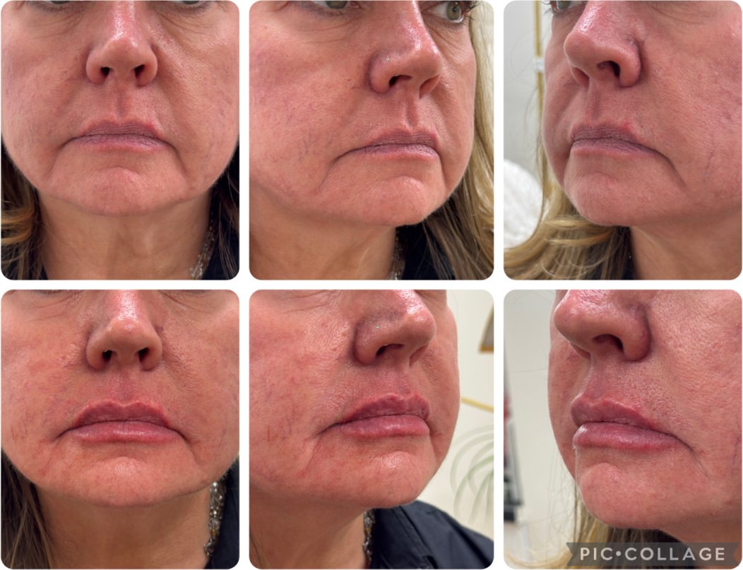Before and after dermal filler treatment of the lips and perioral lines, shown front and both profile views
