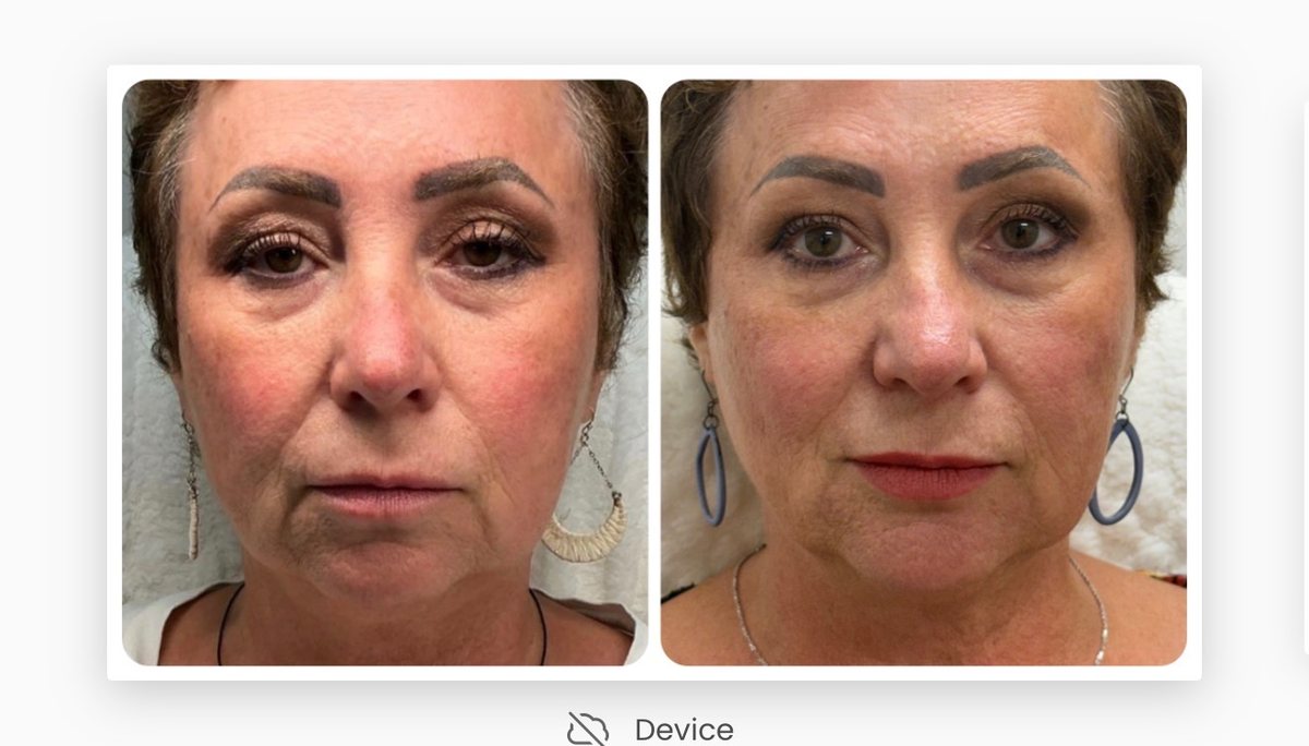 Before and after dermal filler results at TRU Integrative Wellness