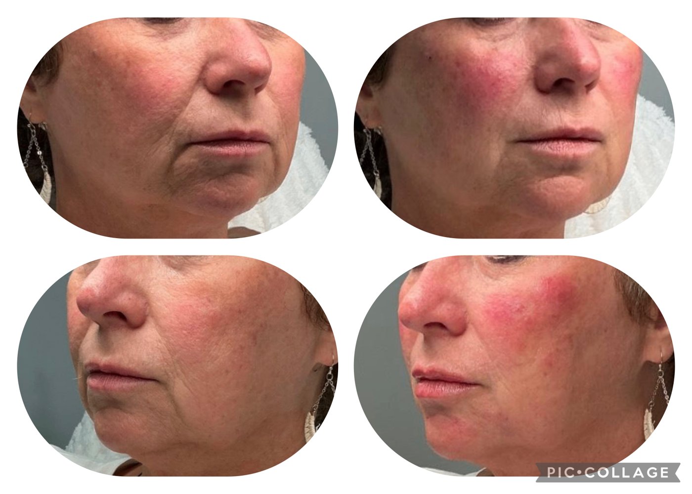 Before and after close-up — softened lines around the mouth and chin after treatment at TRU Integrative Wellness