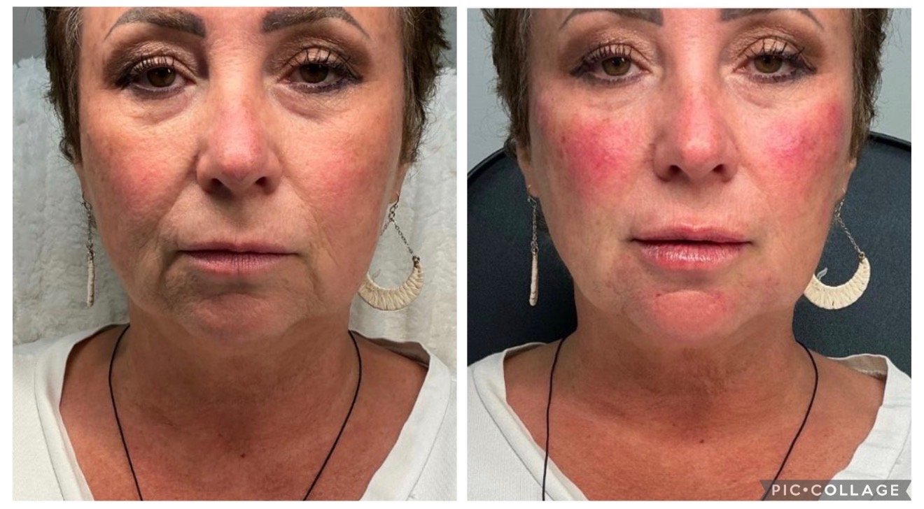 Before and after neurotoxin and aesthetic treatment — front view, TRU Integrative Wellness patient in Downers Grove, IL