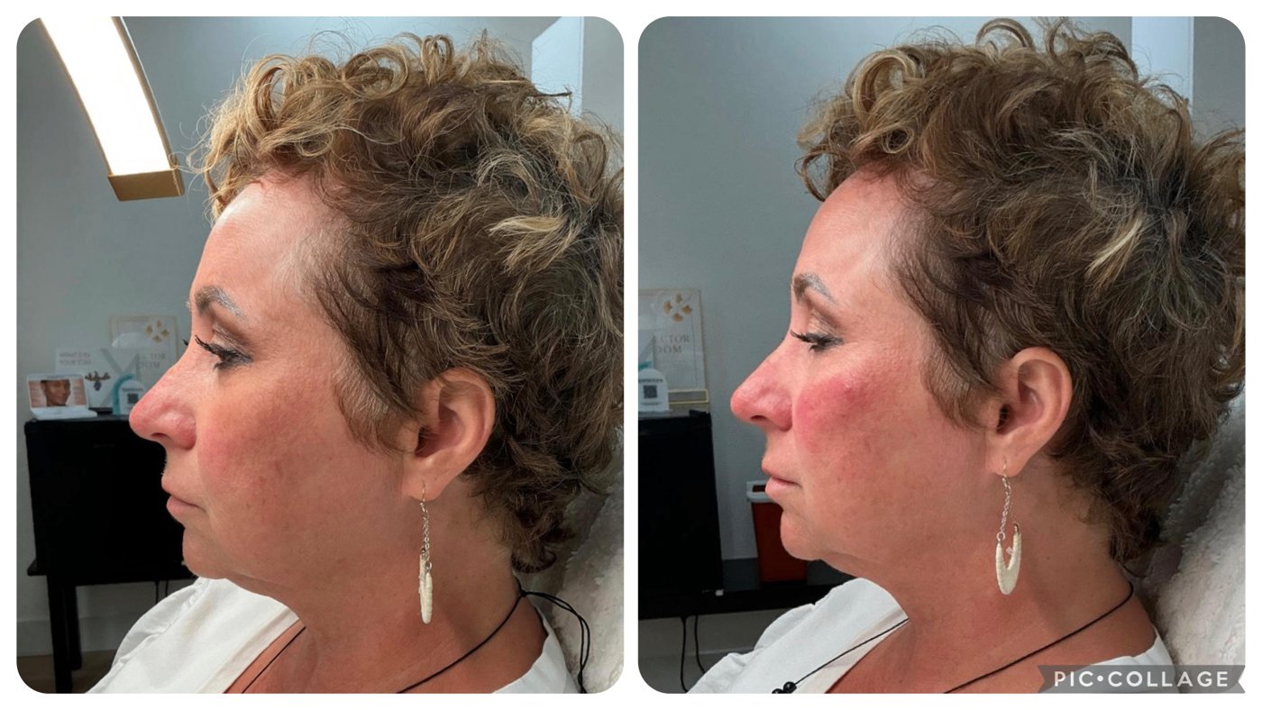 Before and after neurotoxin treatment — profile view showing smoother, more refreshed appearance