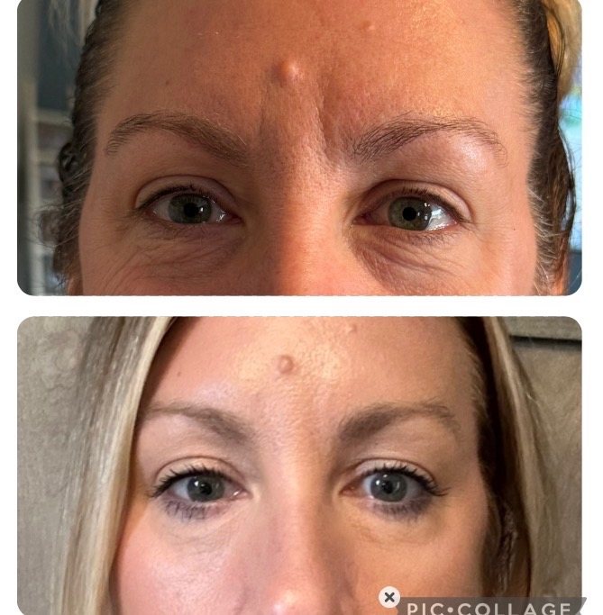 Before and after Xeomin treatment for forehead lines